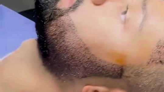 Hair + Beard Transplant